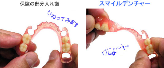 部分入れ歯の比較