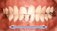 歯ぎしり型（グラインディングタイプ）
