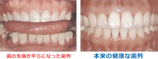 正常な歯並びと歯ぎしりのある歯並びの比較