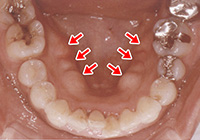 骨隆起によって歯ぐきが膨らみ、触れると硬く骨ばった状態